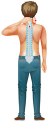 Poster - Back of man with spinal core injury