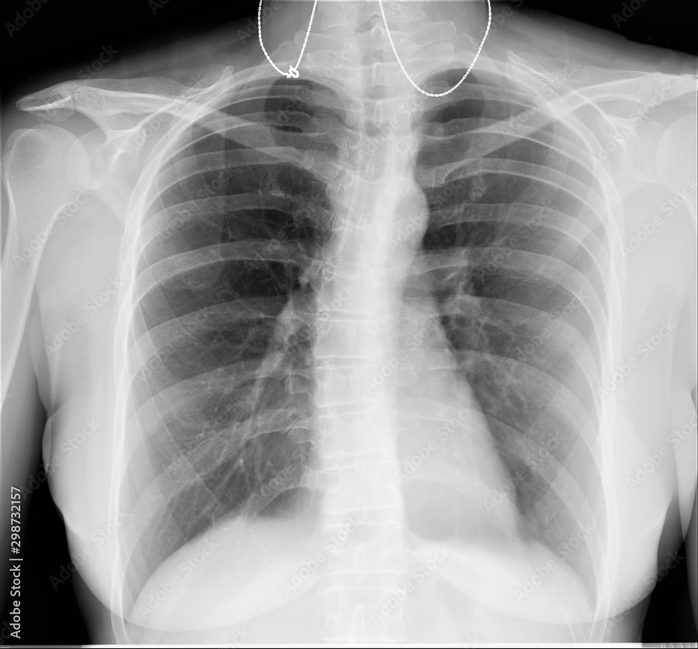 Normal Radiography normal radiography of the chest and lungs,pulmonology, medical ...