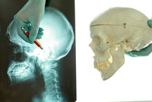  Skull And Neck  At X-ray Film Viewer On The Left , Model Of Skull Bones On The Right. Hand In Glove Pointing On Image