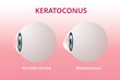 Eye cornea and keratoconus, eye disorder, medical vector