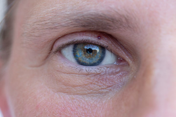 Mature man with blue eye and constricted pupil, closeup view