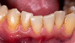 Lower teeth with plaque around them, closeup
