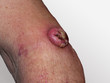 canvas print picture - Bösartiger Tumor auf Haut eines Mannes
