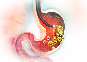 Wall Mural - Stomach cancer. 3d illustration ..