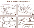 Drawing to show the location and technique of suppository insertion for the delivery of drugs per rectum
