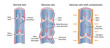 Treatment of varicose veins by compression. The scheme of venous circulation with normal and varicose veins. A longitudinal section of a vein with a description of the main parts. Vector illustration