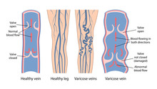 Varicose Veins. Image Of Healthy And Diseased Legs. A Longitudinal Section Of A Vein With A Description Of The Main Parts. Vector Illustration In Flat Style