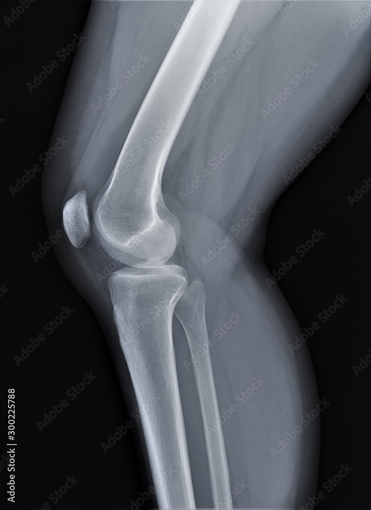 normal radiography of the knee joint in lateral projection, medical ...