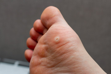 Wart on the foot.  