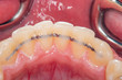retainer in der uk-front nach zahnregulierung