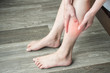 © boyloso - Woman hands holding and massage her calf, suffering from calf pain.