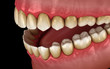 Tartar and bactrail tooth plaque, jaw inflammation. Medically accurate 3D illustration of human teeth treatment