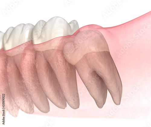 Cuadros en Lienzo Mesial impaction of Wisdom tooth