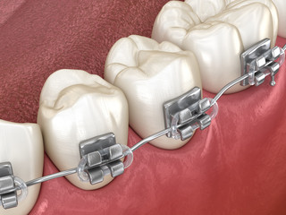 Healthy Teeth with metal braces, Macro view. Medically accurate dental 3D illustration