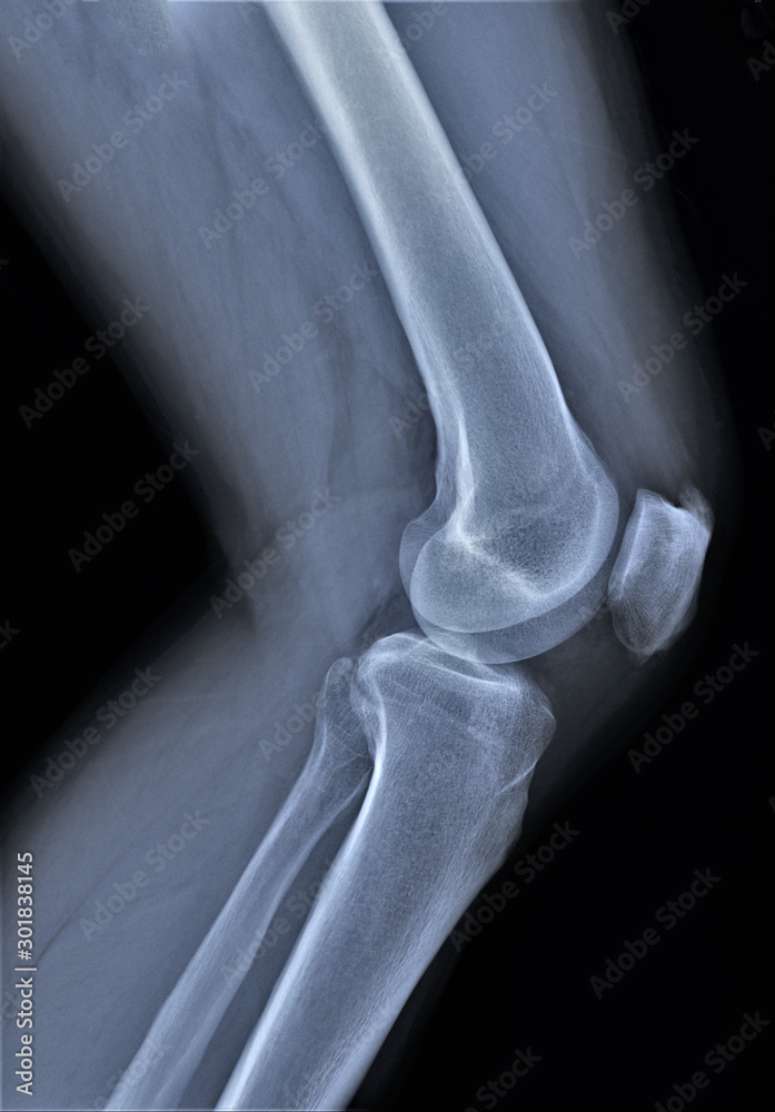 normal radiography of the knee joint in lateral projection, medical ...