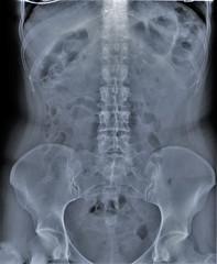Naklejka na meble radiography of lumbar and sacral spine, pelvis, coxarthrosis, medical diagnostics
