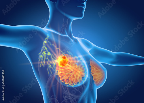 Fotografía Breast cancer with lymphatics, medically 3D illustration