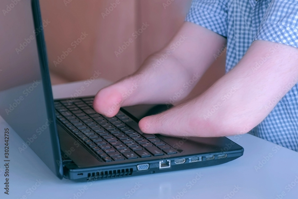 Disabled man with amputated two stump hands working typing on laptop ...