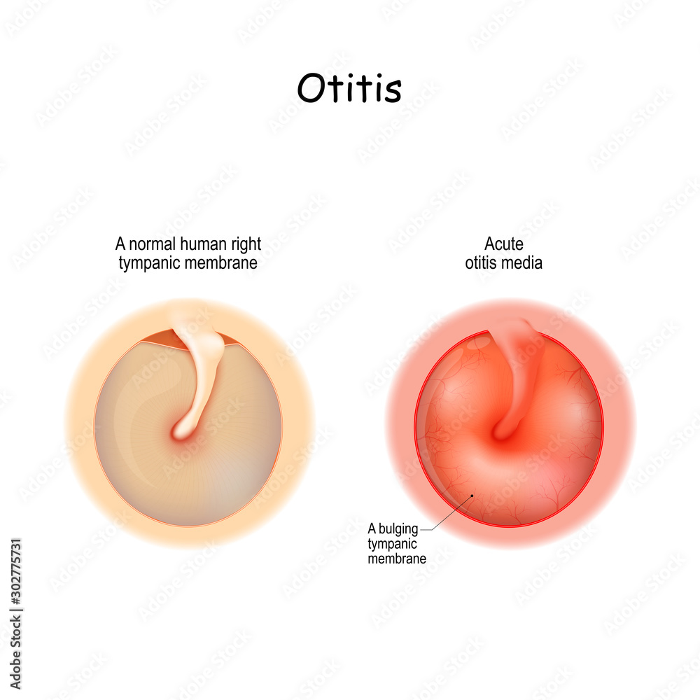 otitis. Healthy membrane, and bulging tympanic membrane of Acute otitis ...