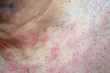 Extreme close-up photography of the atocpic dermatitis symptoms on the upper chest of an adult male.