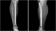 Film leg X-ray radiograph showing leg bone broken (tibia fracture) which treated by close reduction and internal fixation (CRIF) with tibial nail device. Medical equipment and technology concept