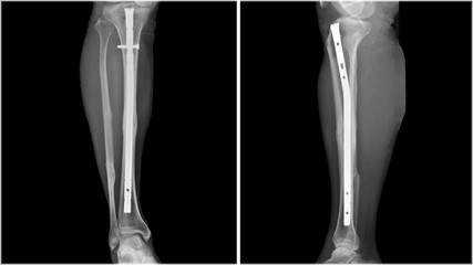 Wall Mural - Film leg X-ray radiograph showing leg bone broken (tibia fracture) which treated by close reduction and internal fixation (CRIF) with tibial nail device. Medical equipment and technology concept