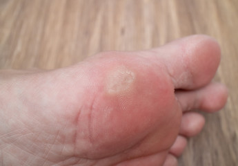 Close-up of corn on woman's foot sole. foot and shoes problem. medecine concept