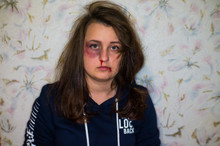 The Battered Young Wife Suffered From Domestic Violence And The Beating And Humiliation Of Her Husband. A Black Eye, A Broken Lip, A Broken Nose, Tousled Hair. Stop Domestic Violence.