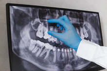 Doctor Points To Filled Root Canal In Dental X-ray
