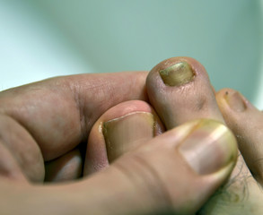 Close-up image of a fingernail on the right foot of a Caucasian man. The signs of mycosis of the small finger nail near the big toe are visible.