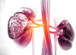 © Rasi - Diseased human kidney on science background. 3d illustration .