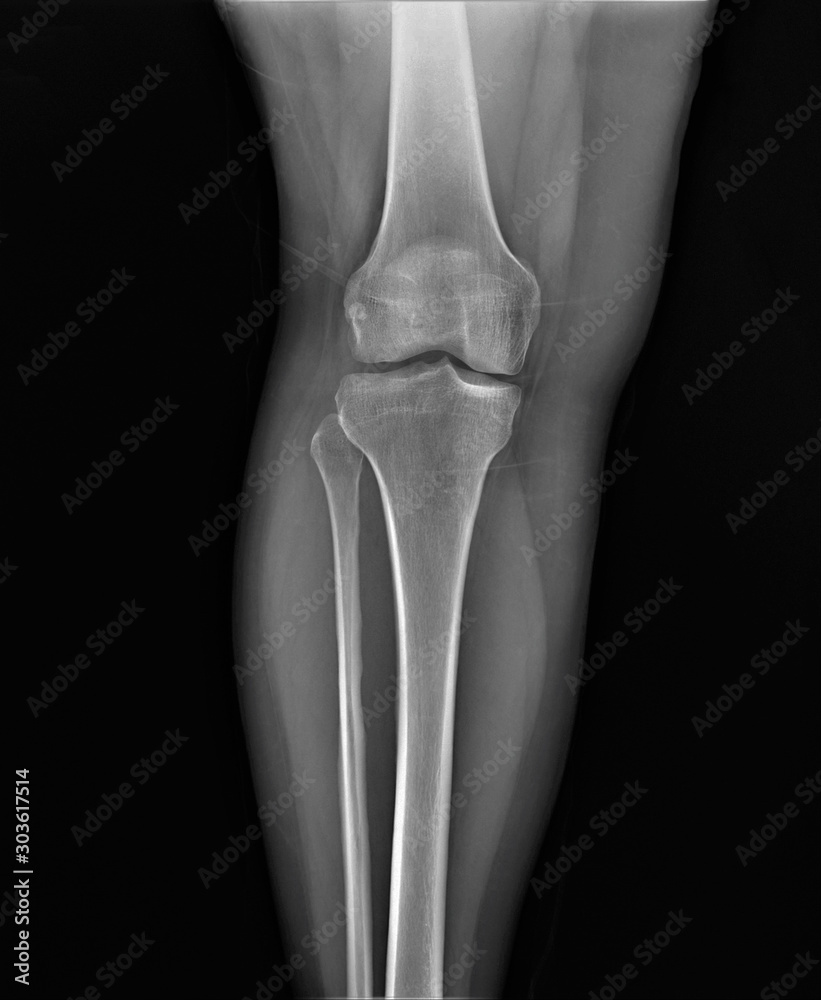 normal radiography of the knee joint in lateral projection, medical ...