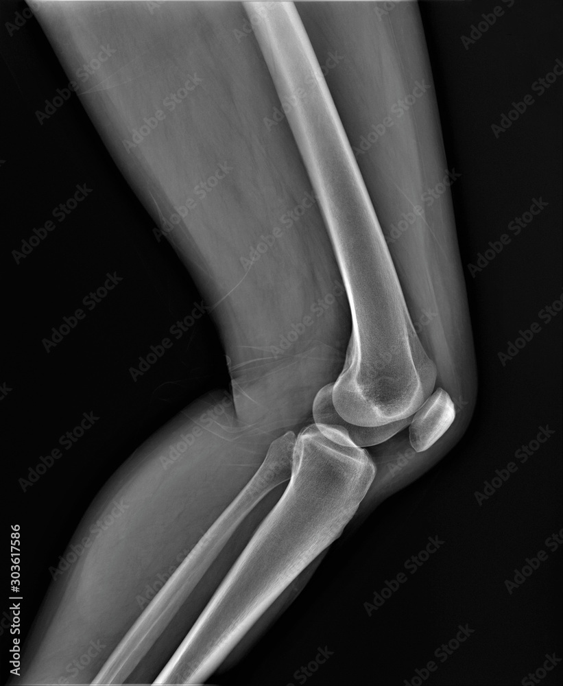normal radiography of the knee joint in lateral projection, medical ...