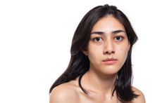 Freckles, Blemish, Pimple, Acne And Dull Skin On Her Beautiful Asian Face. Asian Woman Gets Sad, Beautiful Young Woman Get Problems Of Skin. She Look Unhappy. Were Naked. Isolated On White, Copy Space