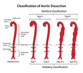 Wall Mural - Classification of aortic dissection: Stanford, DeBakey. Healthy aorta with main parts labeled and aorta with various types of dissection. Vector illustration in flat style isolated on white background