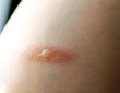Close-up of a burn with a blister on the skin of a hand