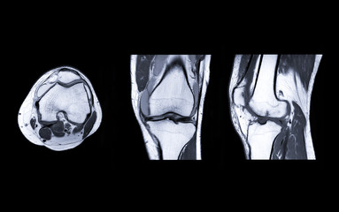 Poster - mri knee joint 3view