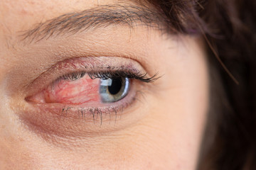 close up of human eye of woman suffering with ocular rosacea, evident redness due to inflammatory co