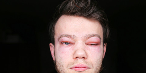 two inflamed red blood eyes of a man affected by conjunctivitis or after the flu, cold or allergy.