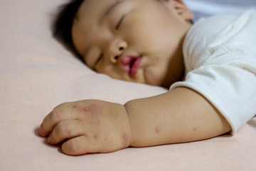 Hand Foot and Mouth disease