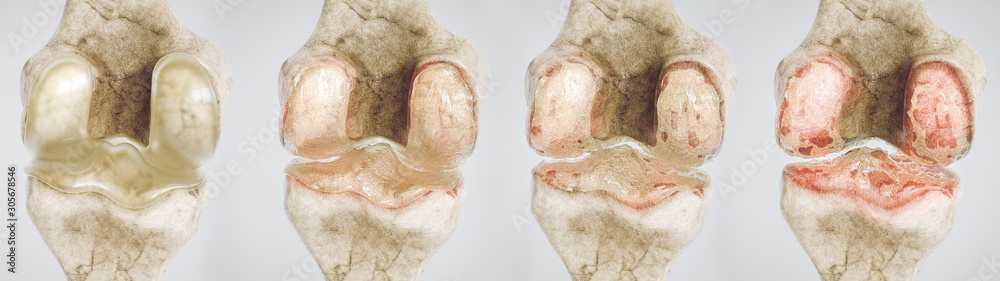 osteoarthritis of the knee in four stages - high degree of detail - 3D ...