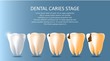 © Siberian Art - Dental caries stages vector medical poster banner template
