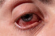 An eyelid is pulled out from a sick eye with inflamed veins from infection