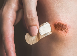 Abrasion on the woman's knee. Girl is applying antiseptic band-aid plaster on the injured leg with a red wound. Medical treatment.