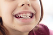 © klavdiyav - Child with removable orthodontic appliance in mouth. Concept of healthy teeth and a beautiful smile.
