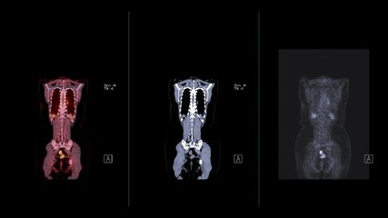 compare ct scan image and pet ct scan fusion image of whole human body coronal plane for detect canc