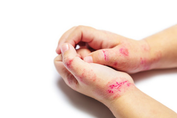 children hand with dermatitis. eczema on hand. Isolated on the white background