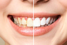 Woman Teeth Before And After Whitening. Over White Background. Dental Clinic Patient. Image Symbolizes Oral Care Dentistry, Stomatology