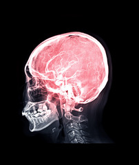 Poster -  Skull x-ray image of Human skull Lateral mix MRV Brain image showing Venous sinuses of brain in skull.