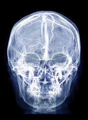 Poster -  Skull x-ray image of Human skull AP view  mix with MRV Brain image showing Venous sinuses of brain in skull.